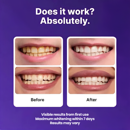 Lunea™ Teeth Whitening Strips